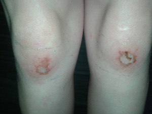 Knees 5 days later