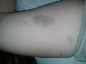 Resultant bruise from rock impact